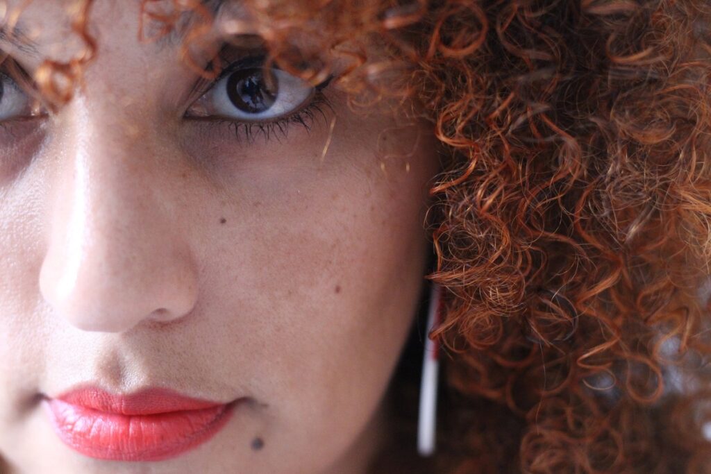 Melasma não é somente uma doença de pele como pensam, afirma dermatologista