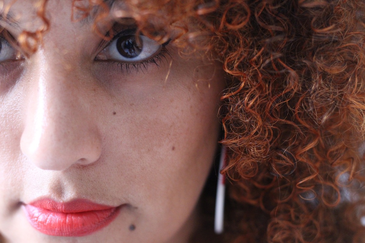 Melasma não é somente uma doença de pele como pensam, afirma dermatologista