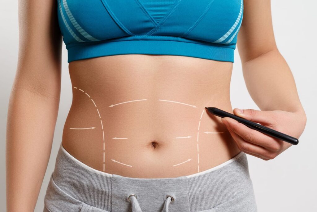 Conheça as principais dúvidas sobre a recuperação pós abdominoplastia