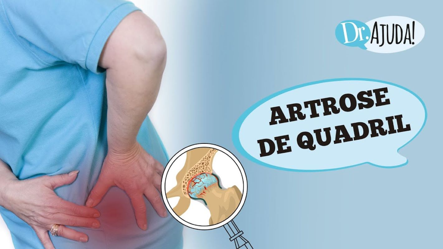 ARTROSE DE QUADRIL: Quando suspeitar? Como tratar?