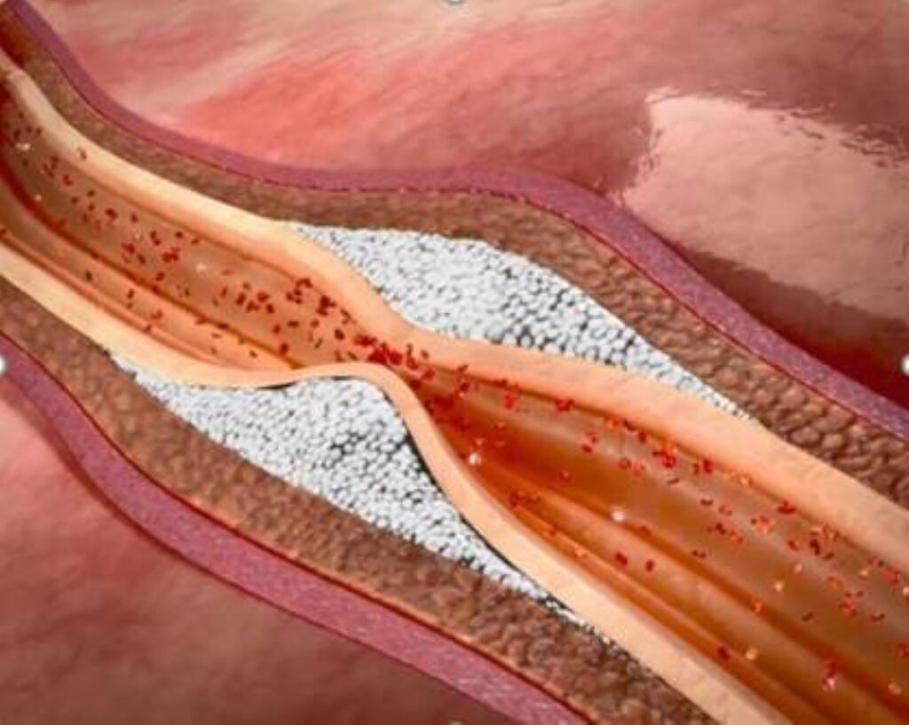 Vitamina K2 tem papel de destaque na prevenção e controle da calcificação arterial