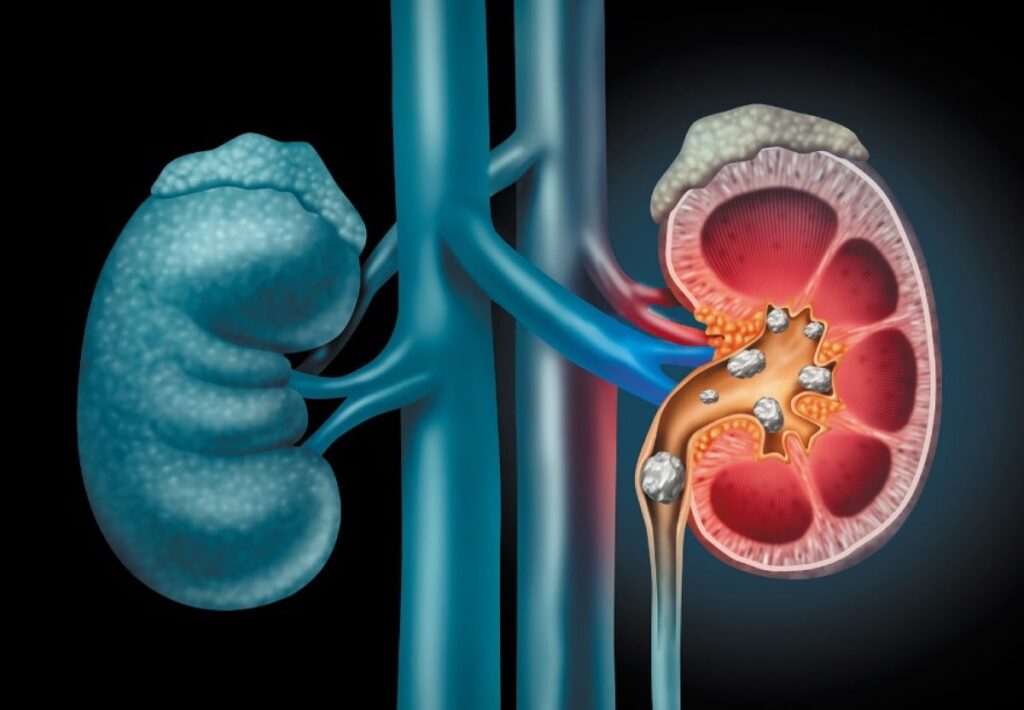 Por que o cálculo renal é mais comum no verão?