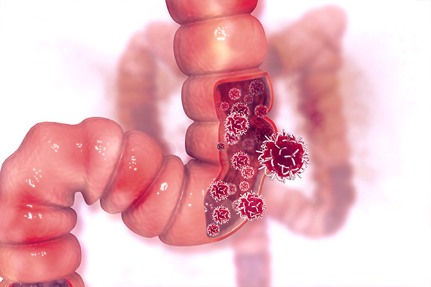 Campanha alerta para necessidade de prevenção do câncer de intestino